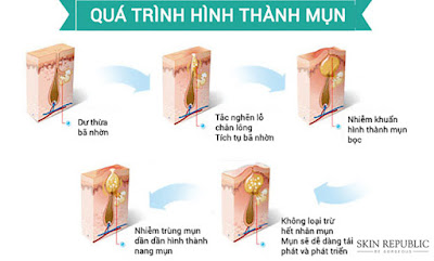 Sự hình thành mụn trên bề mặt của làn da chị em nên biết hiện nay