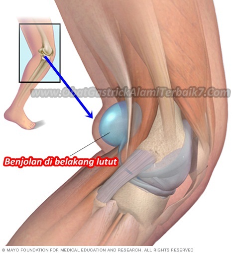 Ubat Untuk Sakit Lutut - Modif 2