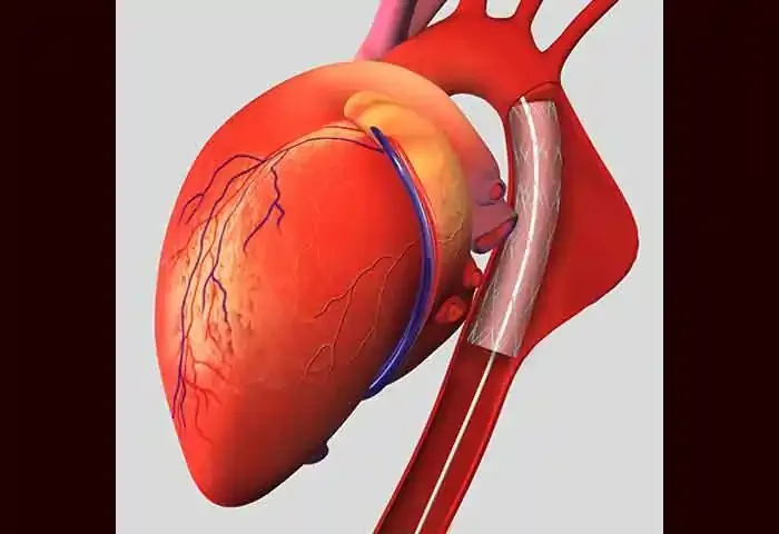 What Is Aortic Aneurysm?