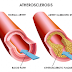 Cara Mengobati Aterosklerosis Secara Alami