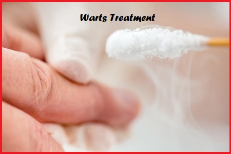 Warts Treatment