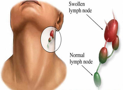 Info - Artis Yang Mengidap Kanser Limfoma ~ VITAMIN WAWA