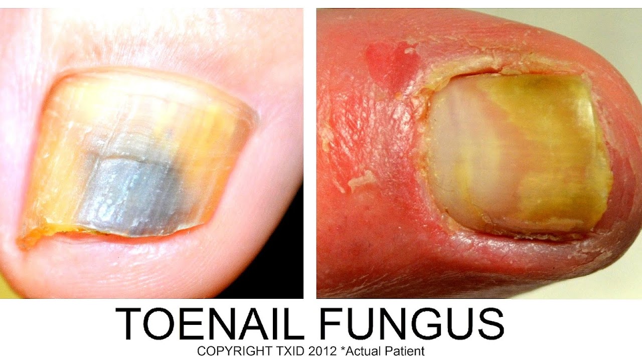 Yellow Fungus Under Toenail