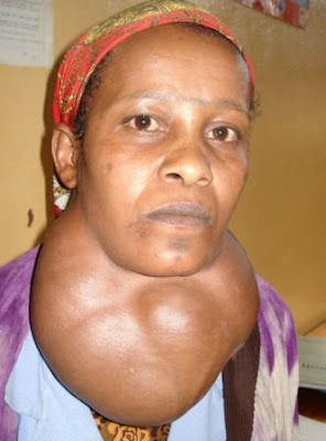 goiter