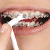 Niềng răng mắc cài kim loại tự buộc có ưu điểm gì?