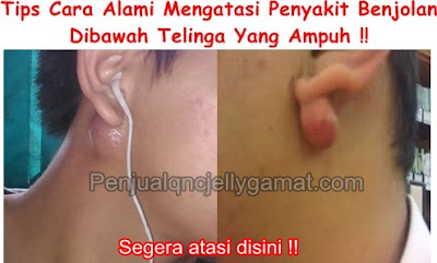 Obat Benjolan Dibawah Telinga Terampuh