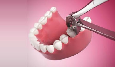 Răng khôn không đau có nên nhổ bỏ?