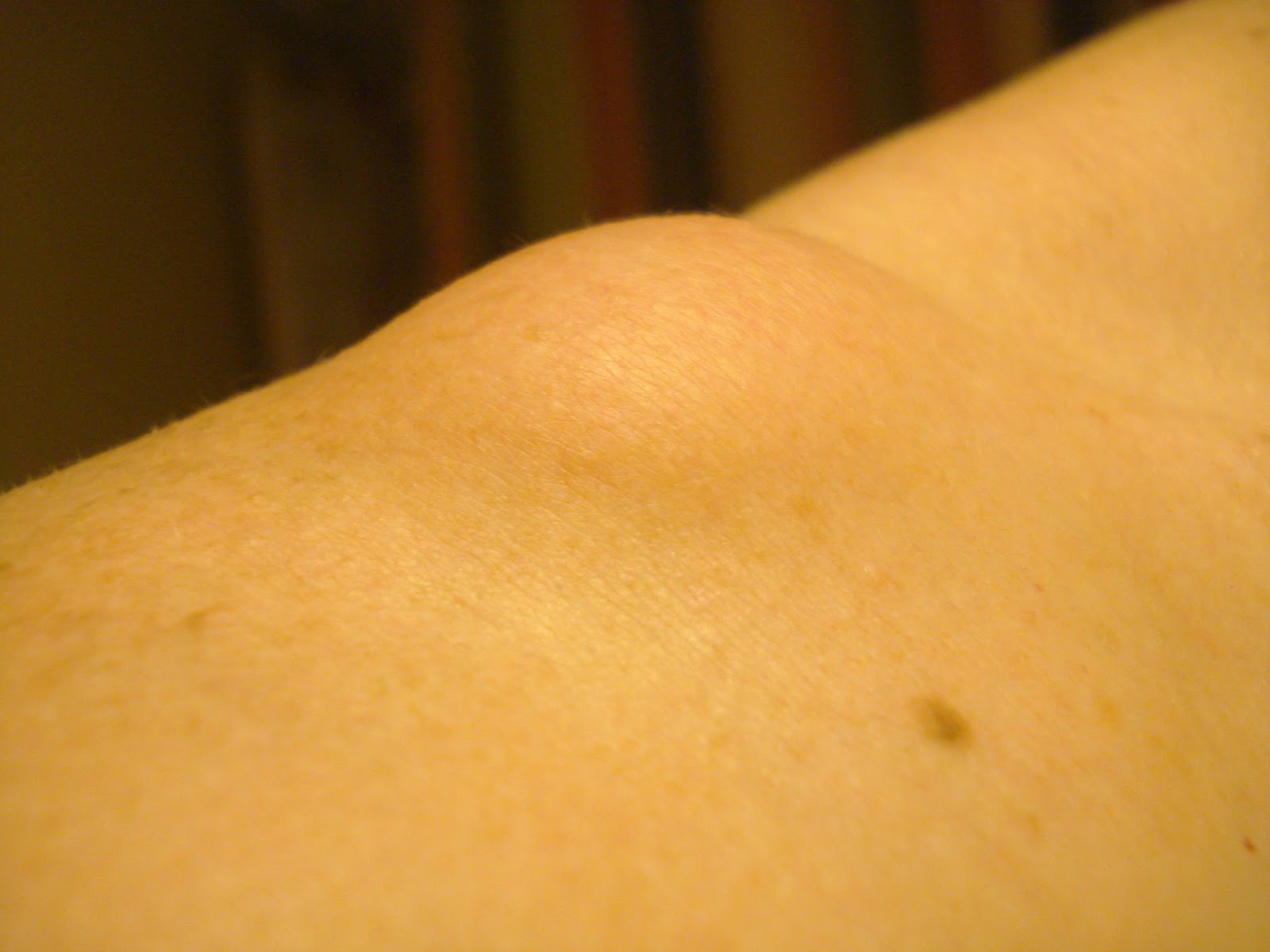 What is this bump on my shoulder? - medical subcutaneous ...