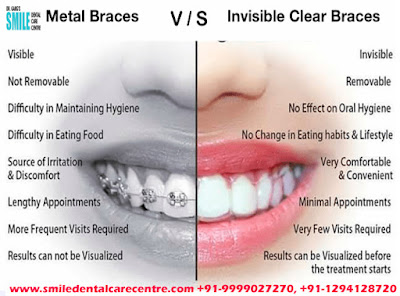 Best Invisible Aligner Treatment