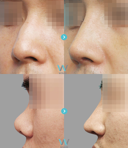 nose job before and after