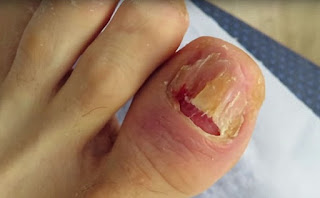 How to Treat Bacterial Nail Infection