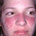 Lupus Symptoms, Lupus: Only Occurs on Women?