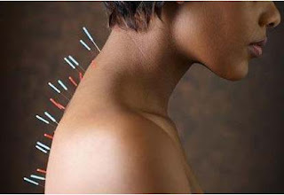 Acupuncture Top Benefits