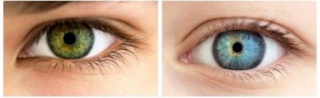 Eyelid Surgery Done