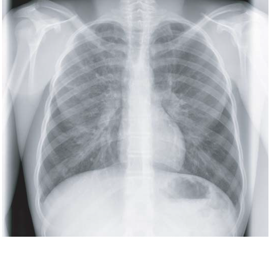 CXR Consolidation Infiltrate | Lungs