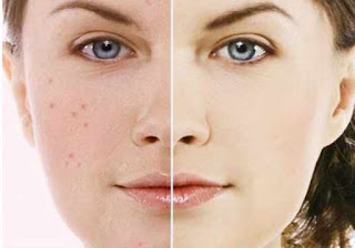 Best Acne Treatment in Gurgaon