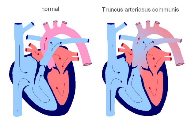 Zur Differentialdiagnose des offenen Ductus arteriosus Botalli