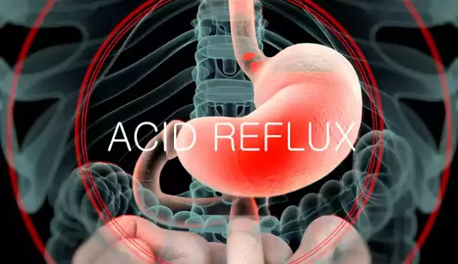 Acid Reflux Essntials | Causes | Symptoms | Treatments