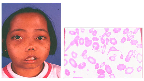 Thalassemia ~ Kapanpunbisa