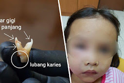 Karena Gigi Berlubang Nyawa Anak Ini Diambang Batas, Dokter Peringatkan Bahaya Makan Manis dan Obat Berlebihan