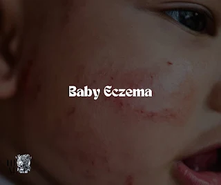 Baby Eczema