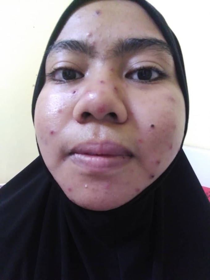 Cara Menghilangkan Parut Chicken Pox