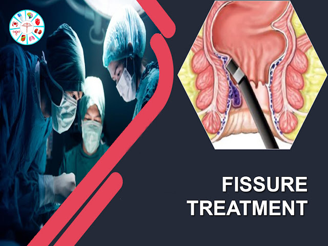 Fissure Treatment in Hyderabad