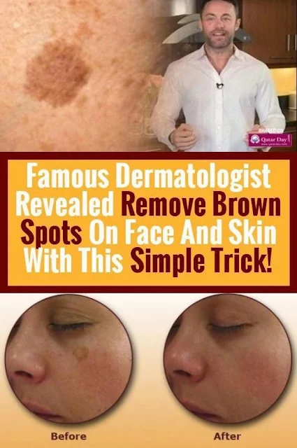 Famous Dermatologist Revealed: Remove Brown Spots On Face And Skin With This Simple Trick!