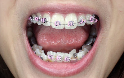 Niềng răng mắc cài kim loại thường - Thông tin cần biết-1