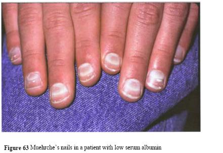 White Nails Disease