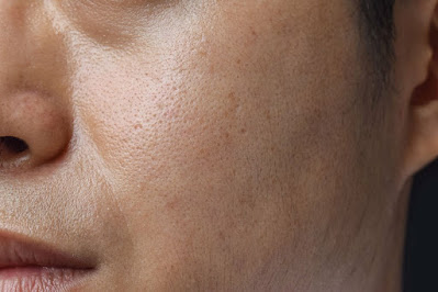 How to Get Rid of Oily Skin