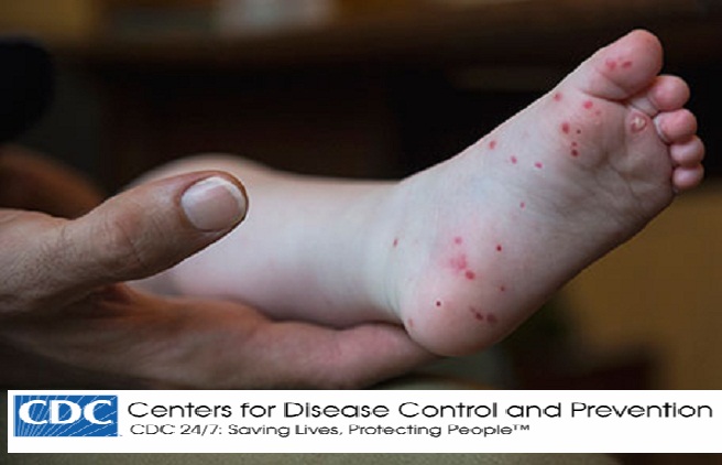  Doença da mão, pé e boca - Síndrome viral-sinais,sintomas,tratamento,prevenção e complicações