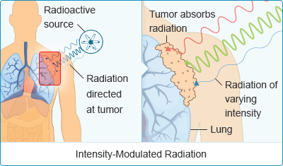 Mesothelioma Radiation