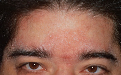 Dermatitis Eksfoliatif Generalisata – Penyebab, Gejala, Cara Mengatasinya