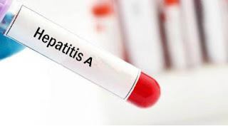 Hepatitis A