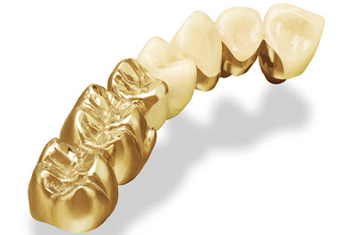 Răng sứ kim loại quý được thiết kế rất tinh xảo