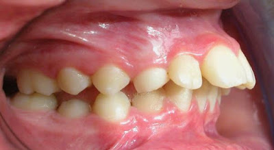 Các hình thức niềng răng hô phổ biến