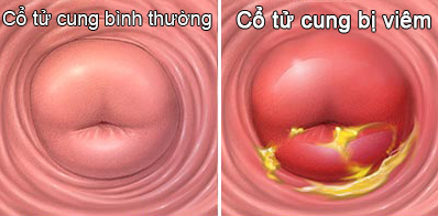 viem-co-tu-cung-la-gi