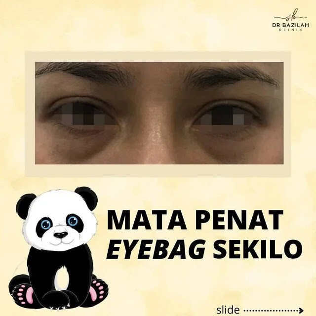 Cara Hilangkan Eyebag dan Dark Circle Dengan Cepat dan Berkesan di Klinik Dr. Bazilah