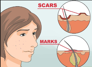 Smooth Skin Again: Removing Acne Scars 