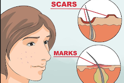 Smooth Skin Again: Removing Acne Scars 