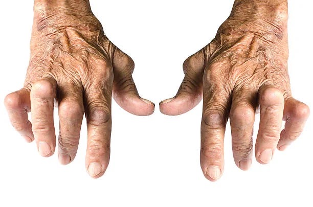 Rheumatoid Arthritis (RA)- Medical & Health 
