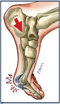 Turf Toes - Turf Toe: Causes, Symptoms, Treatment - YouTube / It happens most often in football players, but it can happen in other sports and.