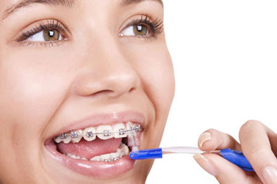  Có phải nhổ răng khi niềng răng không?
