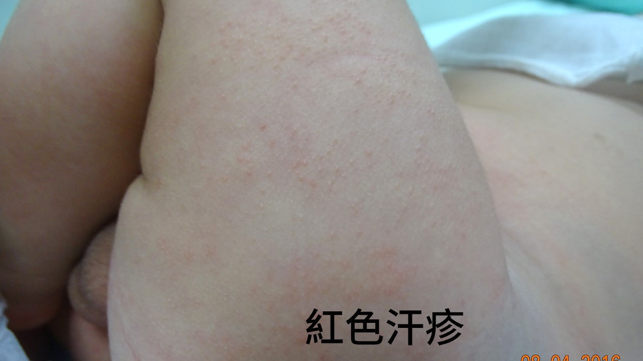 皮膚科賴柏如醫師 異位性皮膚炎乾癬濕敷療法 Po Ju Lai Md 這是異位性皮膚炎嗎 相似卻不是的兒童皮膚疾病