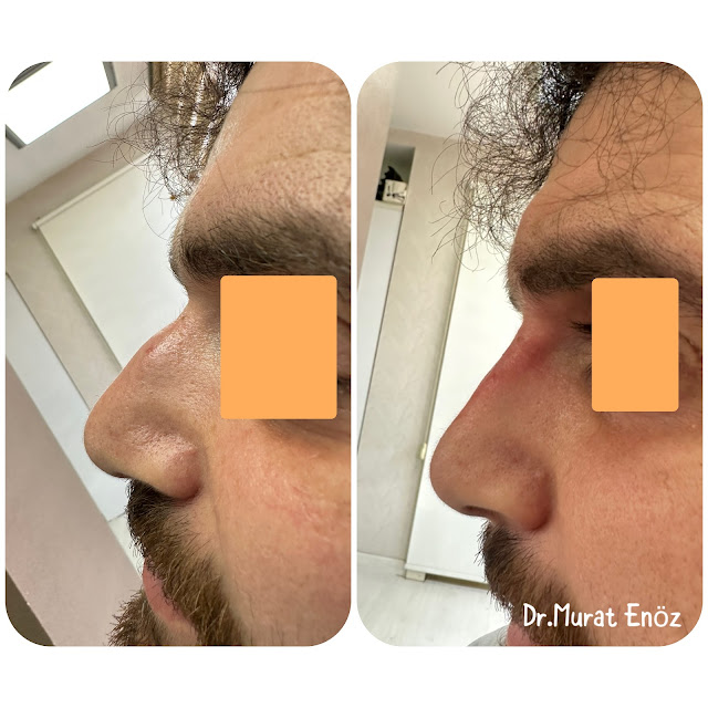 None Surgical Reshaping of The Nose