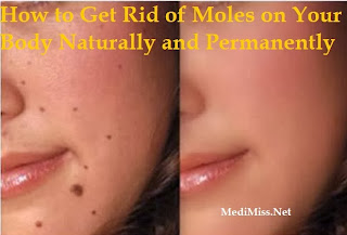 How to Get Rid of Moles on Your Body Naturally and Permanently