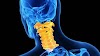  CERVICAL SPONDYLOSIS : MEANING AND SOME KEY POINTS ABOUT IT