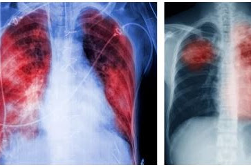 Penyakit TBC (Tuberkulosis) : Penyebab, Gejala, Cara Mencegah Dan Mengobatinya