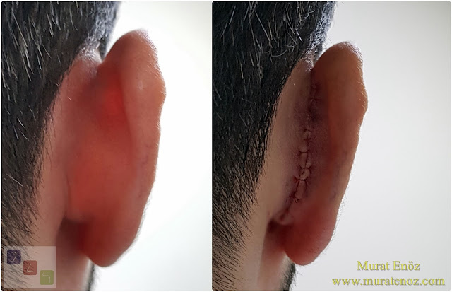 Ear plastic surgery in Istanbul - Modified technique otoplasty - Modified technique auriculoplasty - Correction of prominent ears in Istanbul  - Treatment of protruding ear - Bat ear - Obtrusive ears - Unfolded ears - Cosmetic ear surgery in Istanbul - Before and after photos for ear plastic surgery in Istanbul, Turkey - Protruding ear surgery - Conchomastoid technique for otoplasty